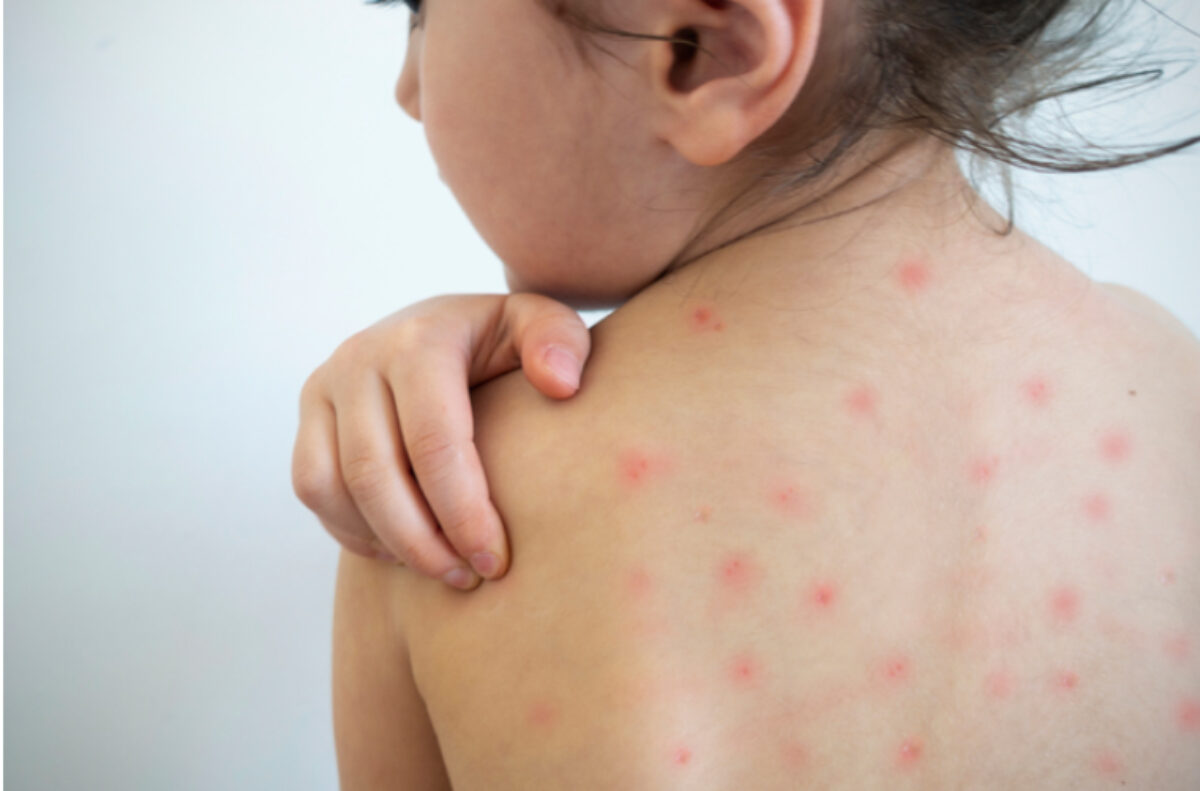RS em alerta contra o sarampo: Saúde recomenda vacinação